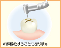 1.むし歯を削ります