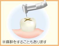 1.むし歯を削ります