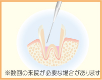 2.必要に応じて、神経を取り除きます