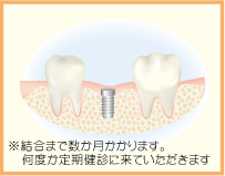 3.インプラントが骨と結合するのを待ちます