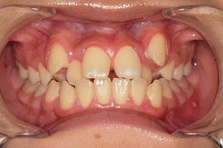 非抜歯による中学生の歯列矯正歯科治療術前