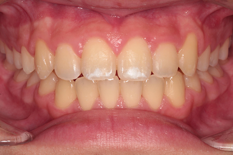非抜歯による中学生の歯列矯正歯科治療術後