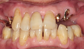 入れ歯作りのプロフェッショナル－歯科技工士① Before