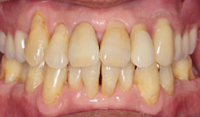 入れ歯作りのプロフェッショナル－歯科技工士① After