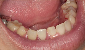入れ歯作りのプロフェッショナル－歯科技工士② After