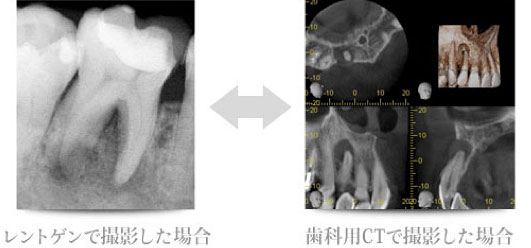 レントゲンで撮影と歯科用CTで撮影の比較