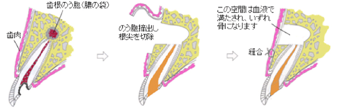 歯根端切除術