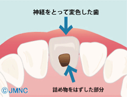 神経をとって変色した歯 詰め物をはずした部分
