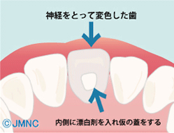 神経をとって変色した歯 内側に漂白剤を入れ仮の蓋をする