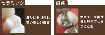 セラミック
周りに気づかれない美しい白さ 銀歯 大きく口を開けると見えてしまうことも