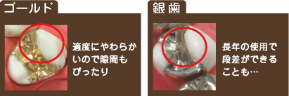 ゴールド 適度にやわらかないので隙間もぴったり 銀歯 長年の使用で段差ができることも…