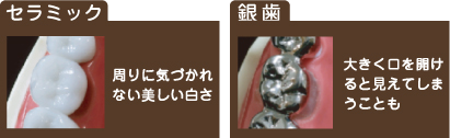 セラミック
周りに気づかれない美しい白さ 銀歯 大きく口を開けると見えてしまうことも