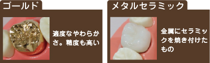 ゴールド 適度なやわらかさ。精度も高い メタルセラミック 金属にセラミックを焼き付けたもの