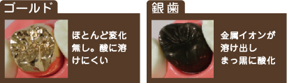 ゴールド ほとんど変化無し。酸に溶けにくい 銀歯 金属イオンが溶け出しまっ黒に酸化