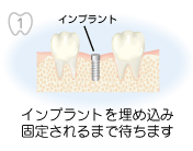 1.インプラント インプラントを埋め込み固定されるまで待ちます