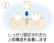 2.しっかり固定されたら上部構造を装着します