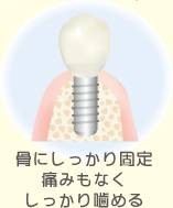 インプラント 骨にしっかり固定痛みもなく しっかり噛める