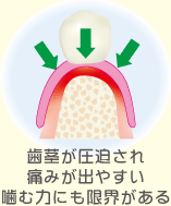 入れ歯 歯茎が圧迫され 痛みあ出やすい 噛む力にも限界がある