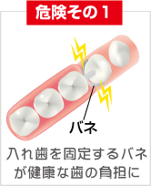 危険その1 バネ 入れ歯を固定するバネが健康な歯の負担に