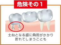 危険その1 土台となる歯は負担がかかり折れてしまうことも
