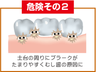 危険その2 土台の周りにプラークがたまりやすくむし歯の原因に